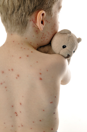 Kind mit Allergie Rote Punkte am Ruecken